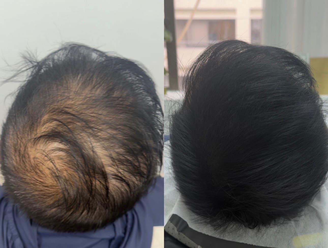 改善頭髮稀疏